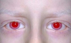 albino-new-york-fires-white-people Albinos need not apply in the state of New York