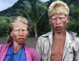 albinos-tanzania