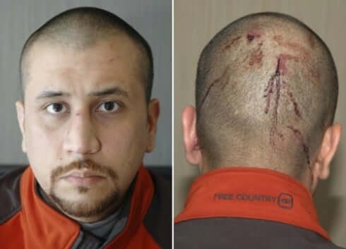 zimmerman-head-wound-brand-name zimmerman-head-wound-brand-name